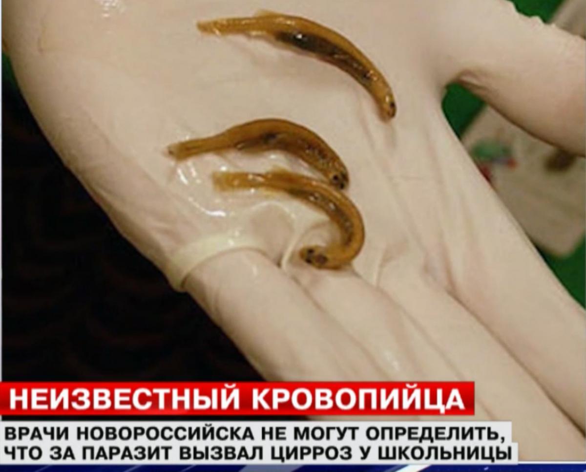 Опасный паразит съел печень у девочки из Новороссийска