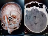 На Кубани нейрохирурги извлекли из мозга мужчины 30-сантиметровый зубец от вил